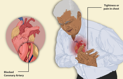 Symptoms of Cardiac Arrest