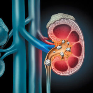 What causes the formation of kidney stones?