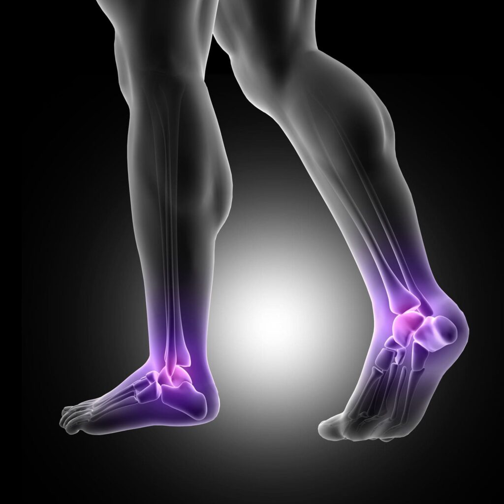 what are bone spurs?