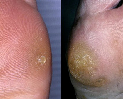 All About Corns and Calluses Treatment