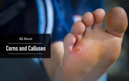 All About Corns and Calluses