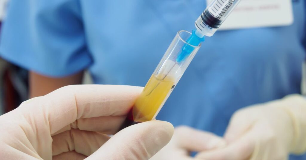 platelet-rich plasma treatment