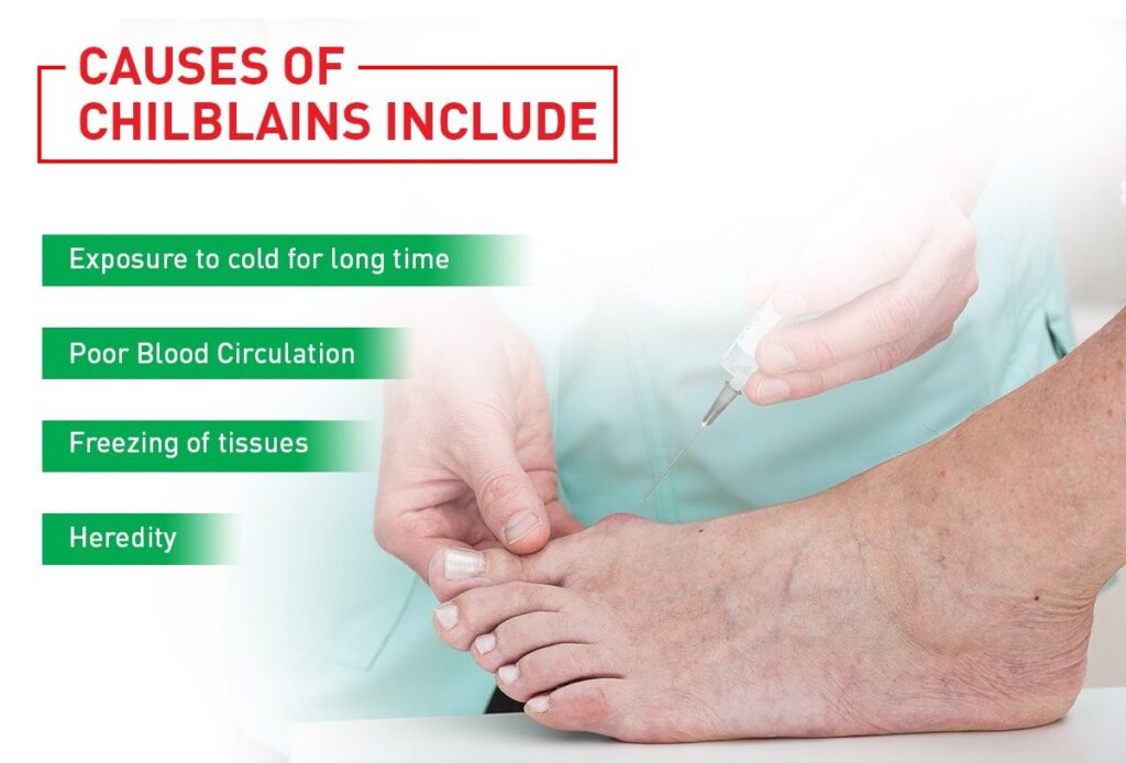 Chilblains