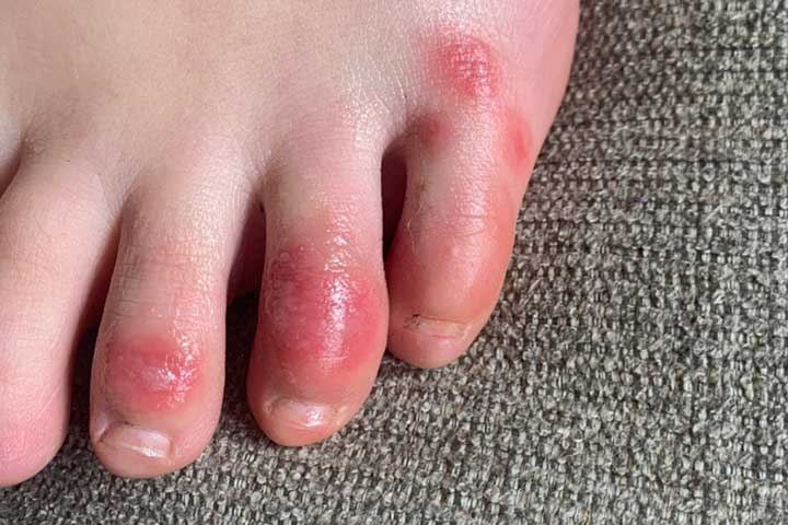 Chilblain Toes