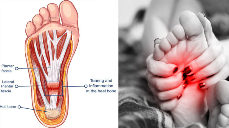 Chronic Foot Pain