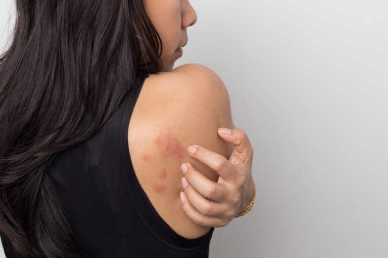 What is Chronic Hives?