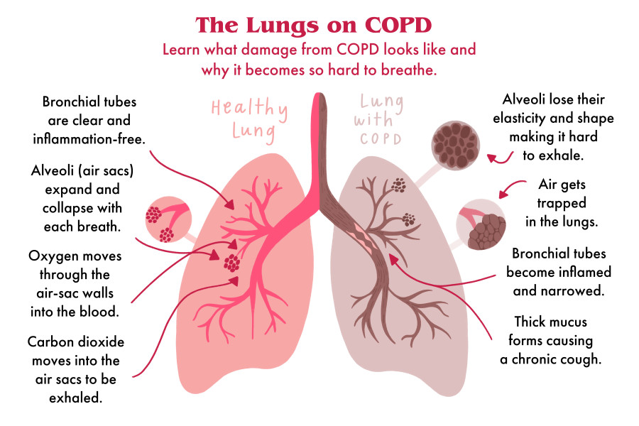 Lung damage caused by COPD