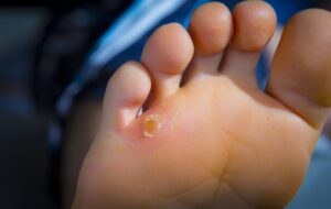 All about Corns and Calluses