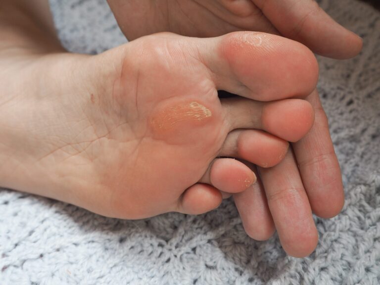 Corns and Callus due to Tight Heels