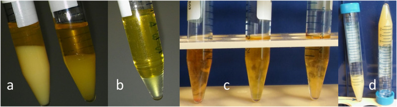 CRYOGLOBULINEMIA DIAGNOSIS