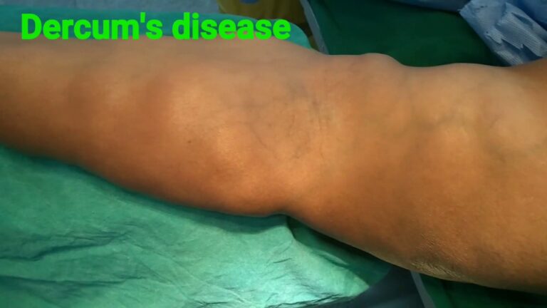 What is Dercum's Disease?