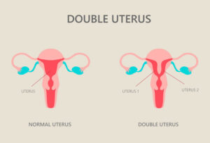 What is a Double Uterus?