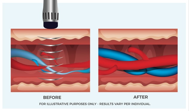 Extracorporeal Shock Wave Therapy