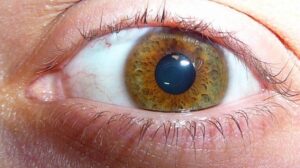 What is Eye Melanoma?