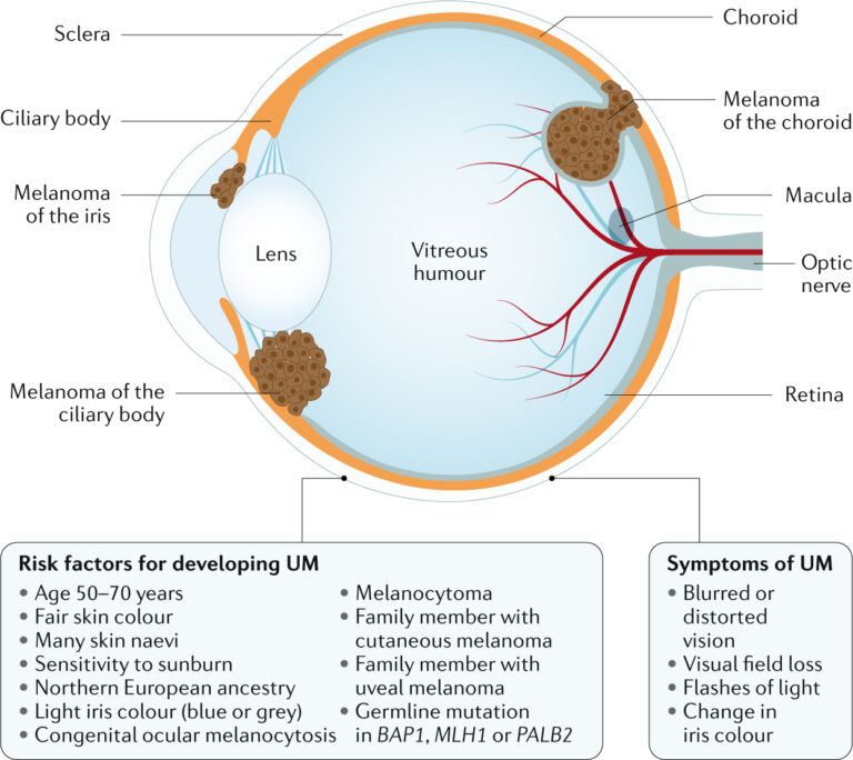 Eye Melanoma