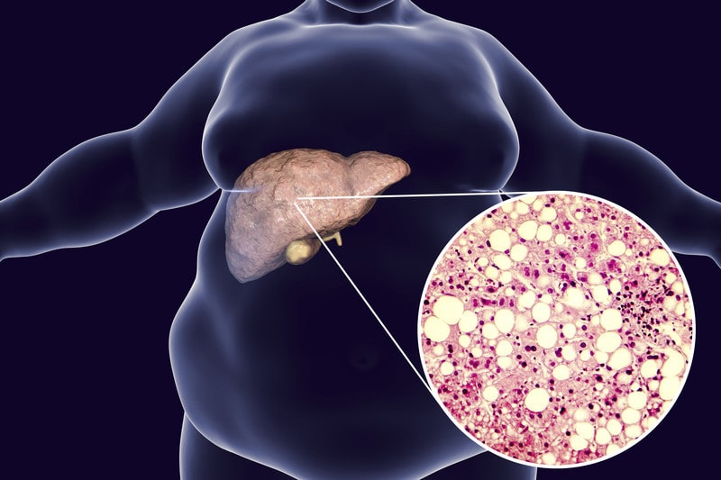 fatty liver disease symptoms