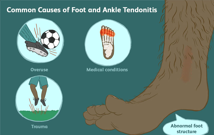 CAUSE OF FOOT AND ANKLE TENDONITIS
