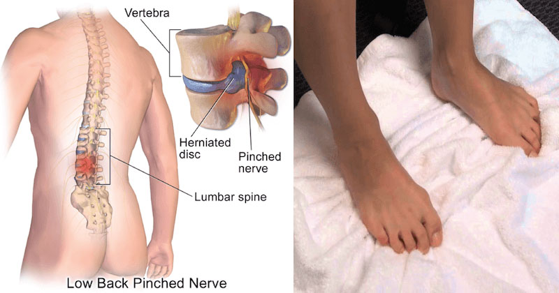 FOOT PAIN CAUSED BY SPINAL PROBLEMS