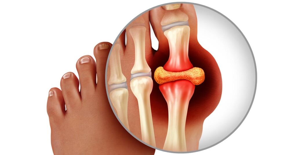 GOUT: URIC ACID PAIN