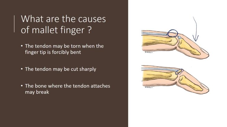 Causes of Mallet Finger