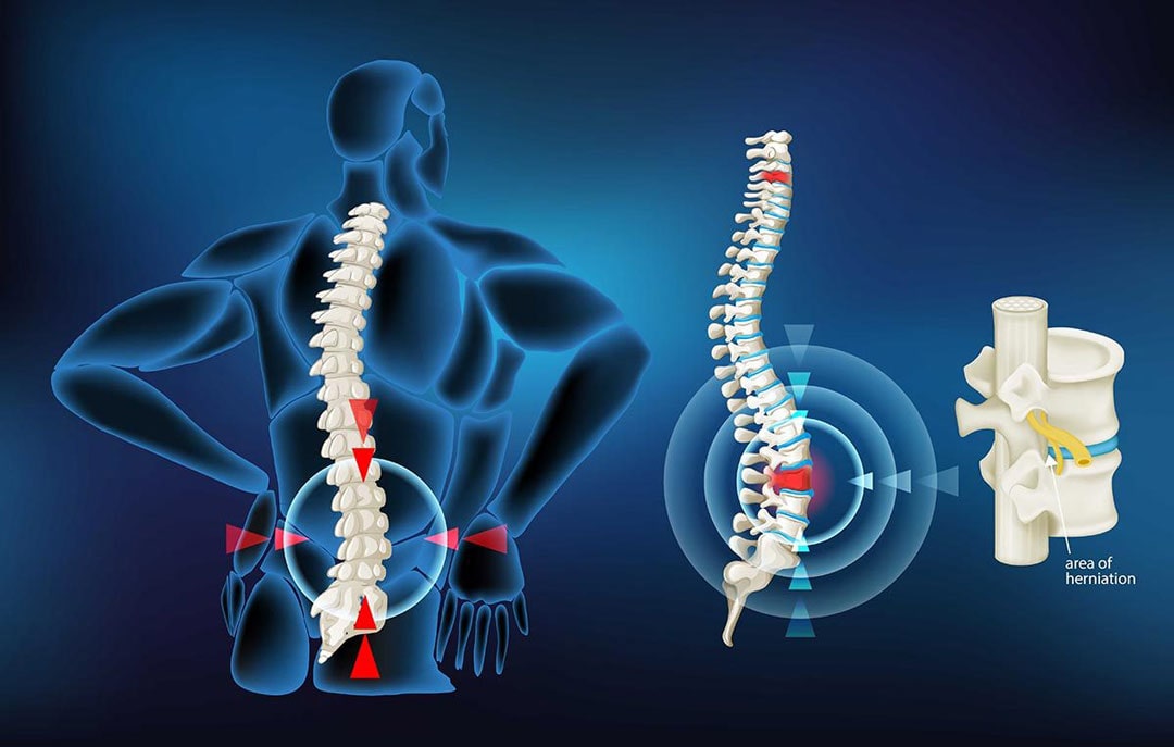 Common Cause for Back Pain: Herniated Disk