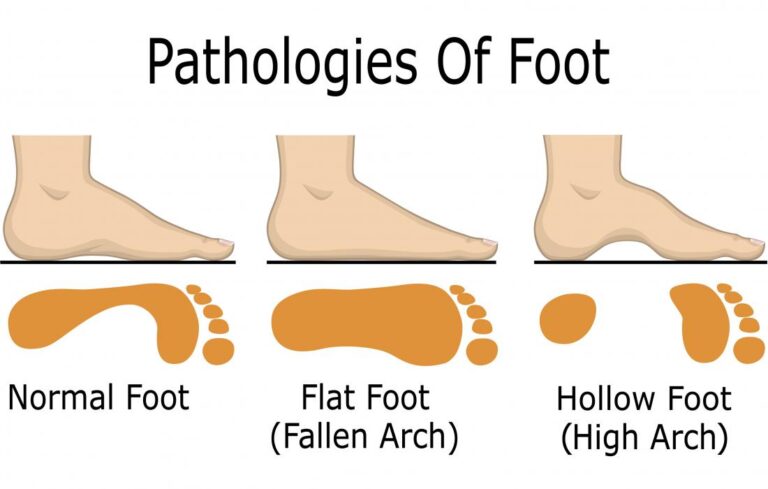 how obesity impacts your feet