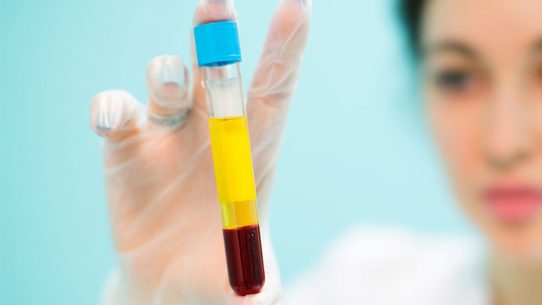 platelet-rich plasma therapy