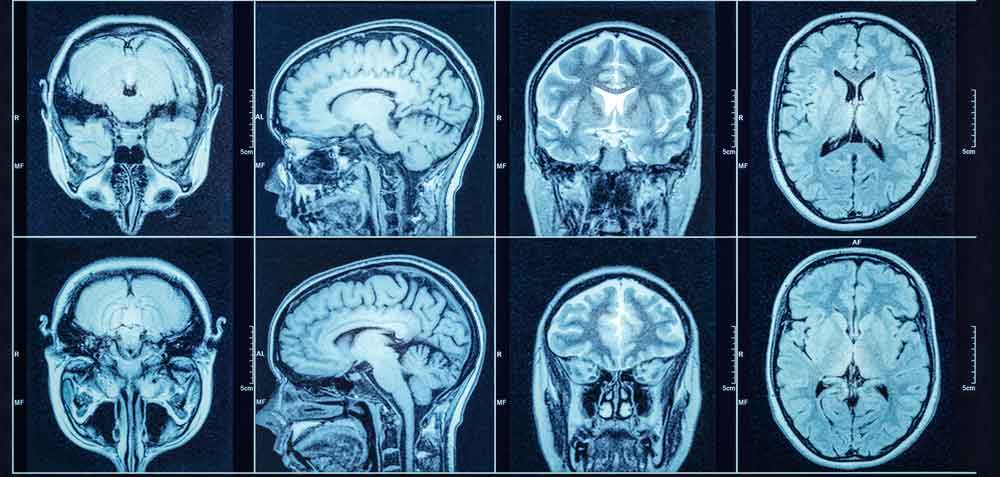 PRP therapy for brain injury