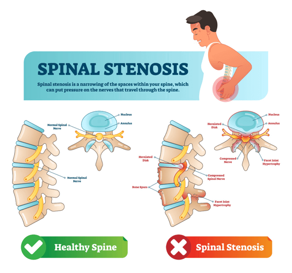 SPINAL STENOSIS