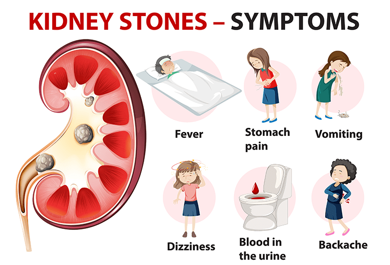 kidney stones symptoms