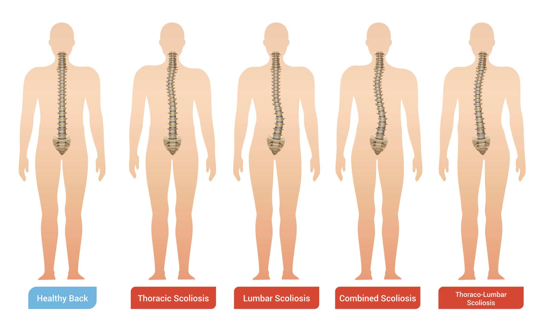 Scoliosis Surgery: Causes, Symptoms, and Treatment