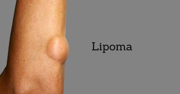 Lipoma Symptoms