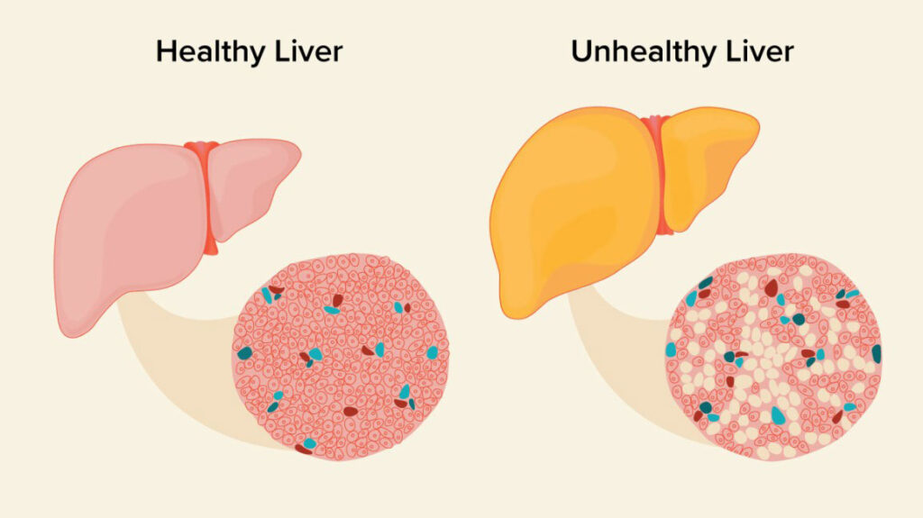 Compare with Healthy Liver and Unhealthy Liver