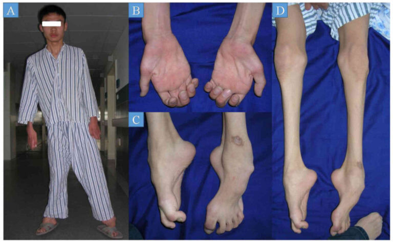 Charcot Marie Tooth Disease Treatment