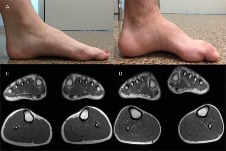 Charcot Marie Tooth Disease Diagnosis