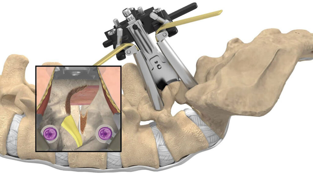 Minimally Invasive Lumbar Decompression Procedure