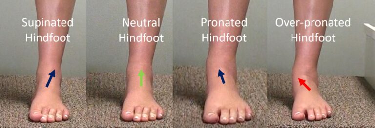Causes of Misaligned Feet