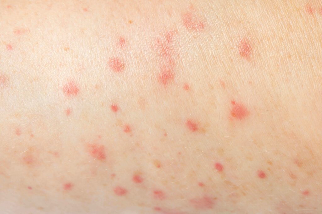 Monkeypox symptoms 