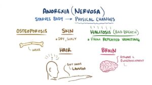 anorexia nervosa