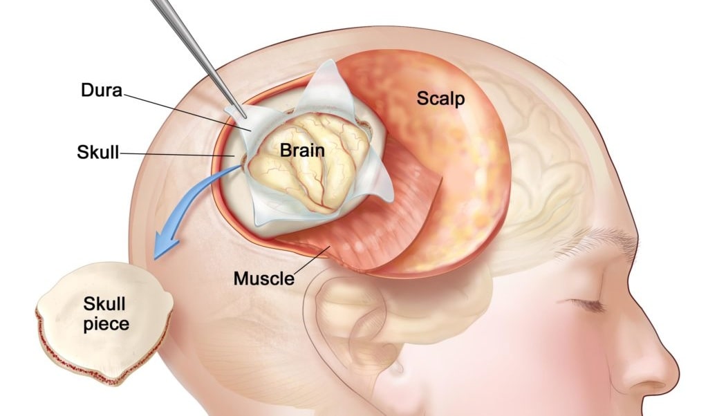 neuroendoscopy treatment