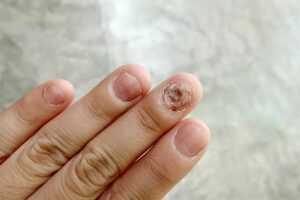 Ultimate Guide to Nail Fungus: Causes, Symptoms, and Treatment