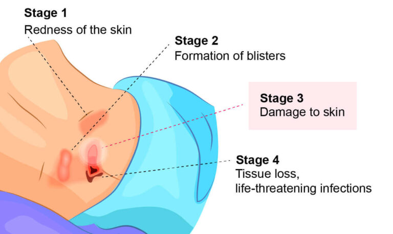 Symptoms of Open Wounds