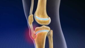 Osgood-Schlatter Disease: Causes, Symptoms, and Treatment