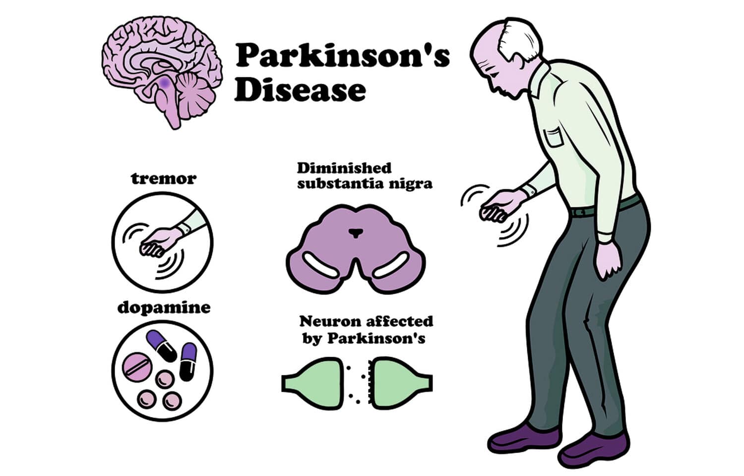 parkinson’s disease