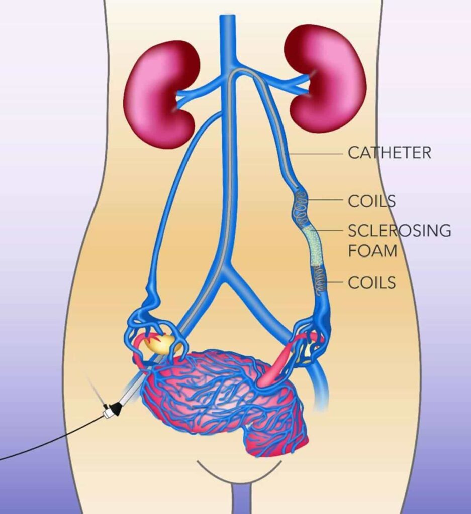 Pelvic Congestion Syndrome