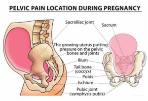 What is Pelvic Girdle Pain?
