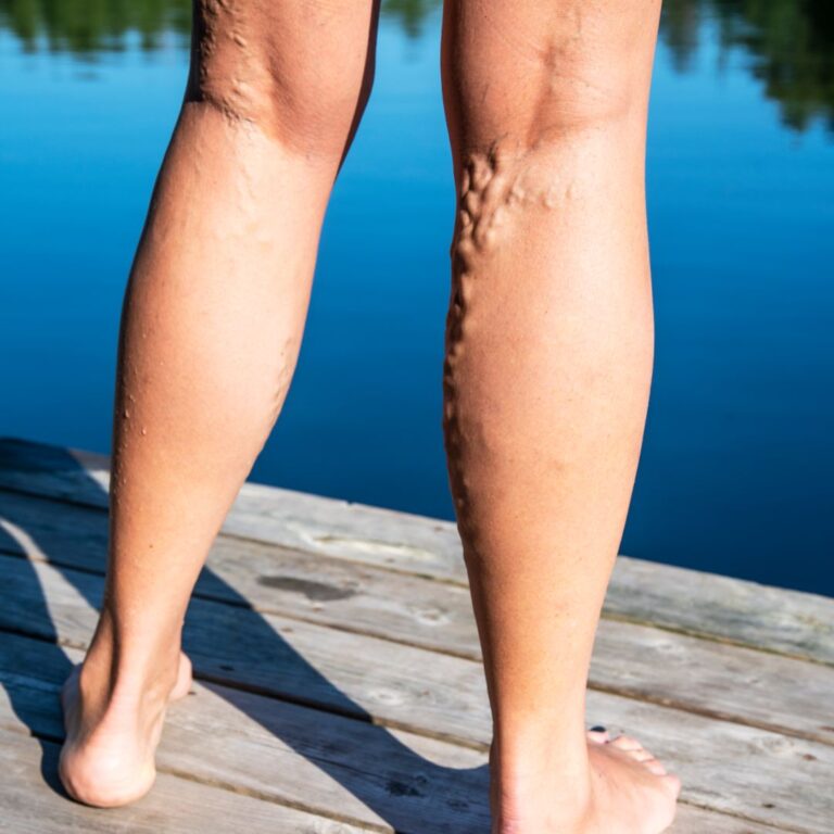 How to Recognize Peripheral Vascular Disease