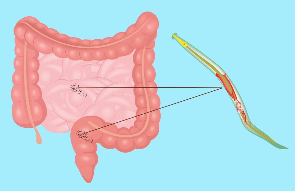 What is Pinworm Infection?