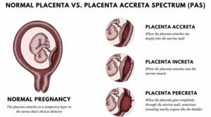 What is Placenta Accreta?