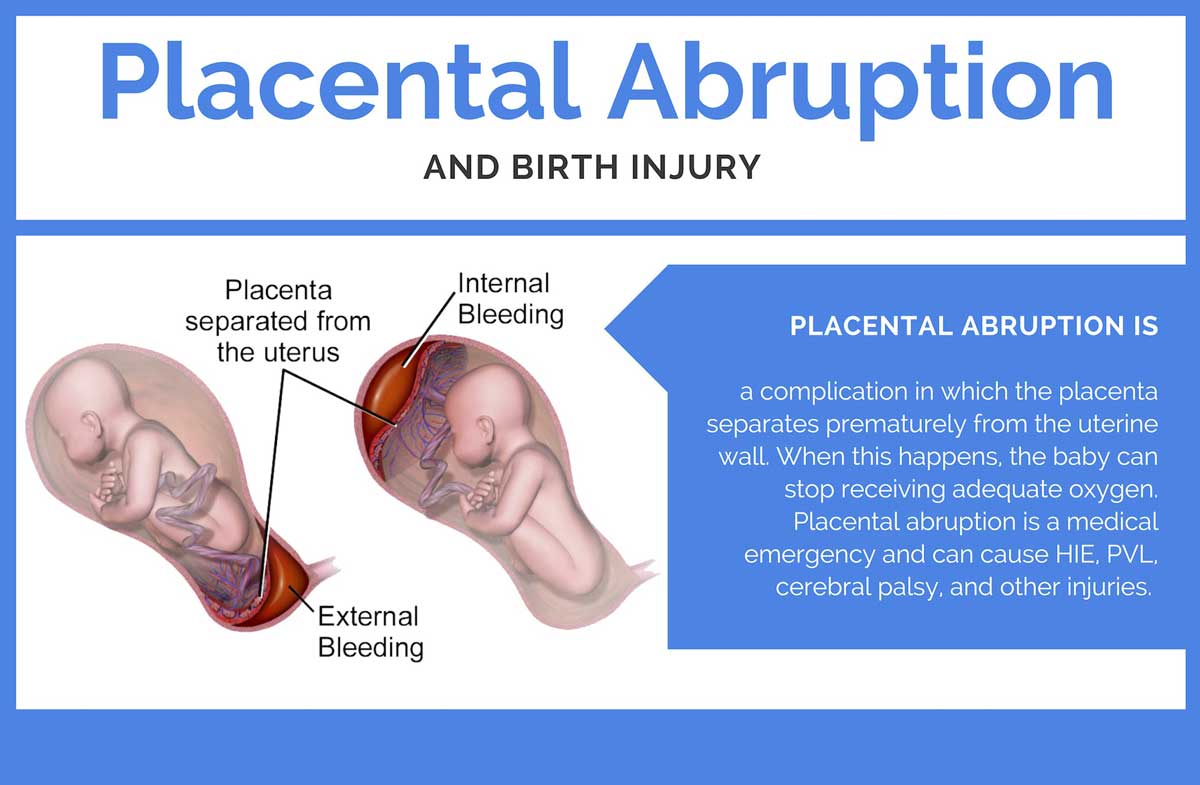 What is Placental Abruption? 